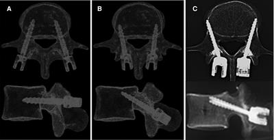 Biomechanical investigation of the hybrid modified cortical bone screw–pedicle screw fixation technique: Finite-element analysis